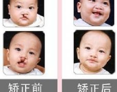 吃兔肉真的會(huì)長(zhǎng)兔唇？為什么會(huì)長(zhǎng)兔唇？